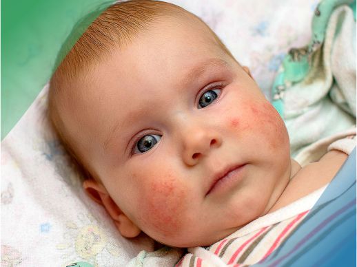 Атопический дерматит у детей
