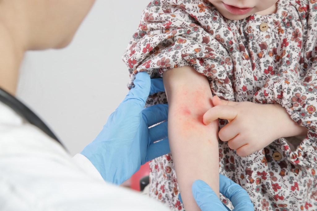 Профилактика атопического дерматита у детей